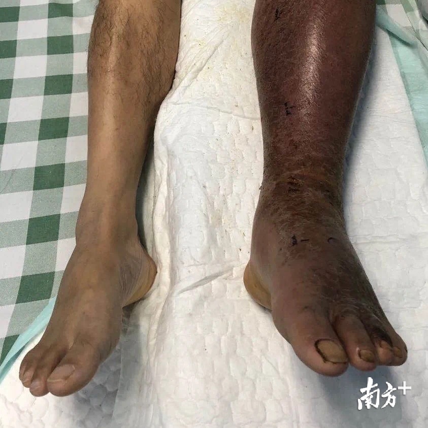 被蛇咬饮药酒险断臂