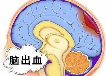 女生突发脑出血 症状是不会说英语